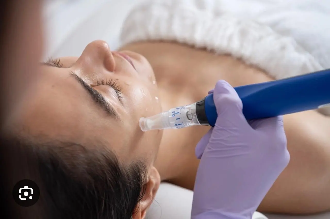 Microneedling spa therapy