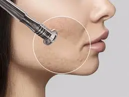 microdermabrasion
